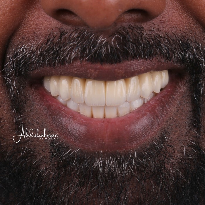 After full-arch implant rehabilitation