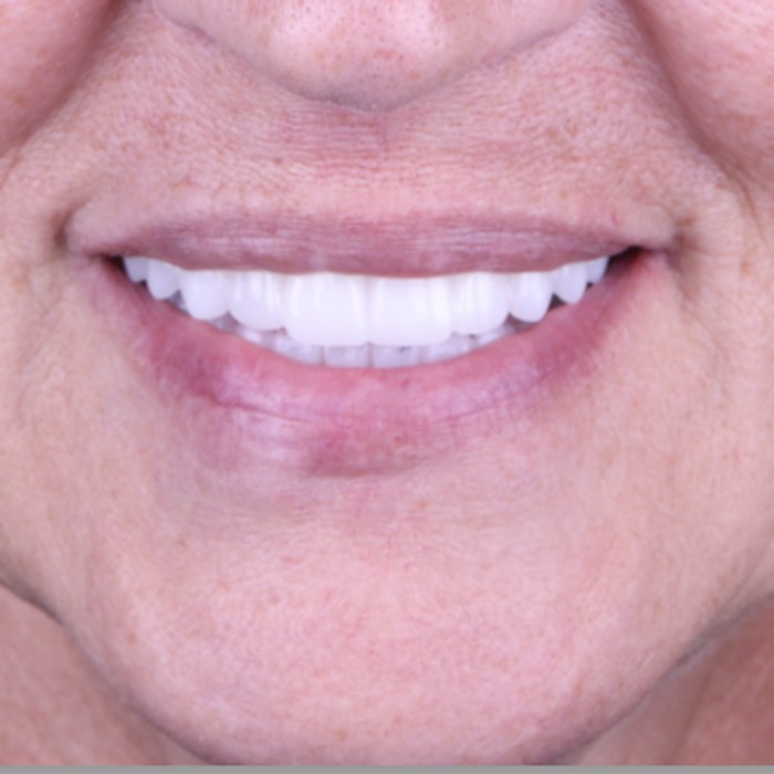 After full-mouth immediate implant rehabilitation
