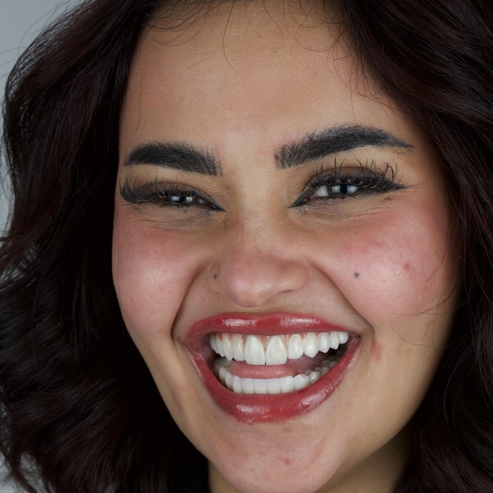 After full-mouth implant rehabilitation