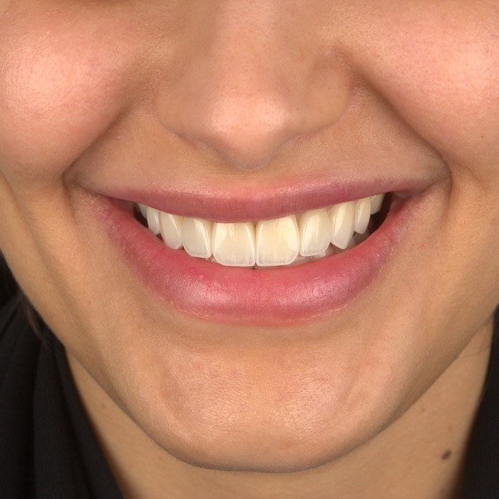 After porcelain veneers
