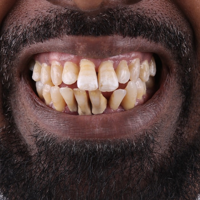 Before full-arch implant rehabilitation