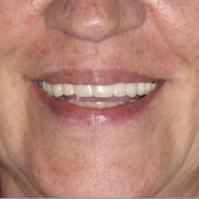 Before full-mouth immediate implant rehabilitation