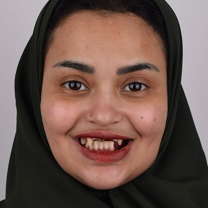Before full-mouth implant rehabilitation