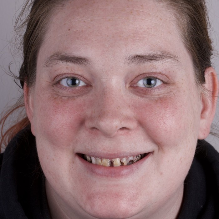 Before implant overdenture