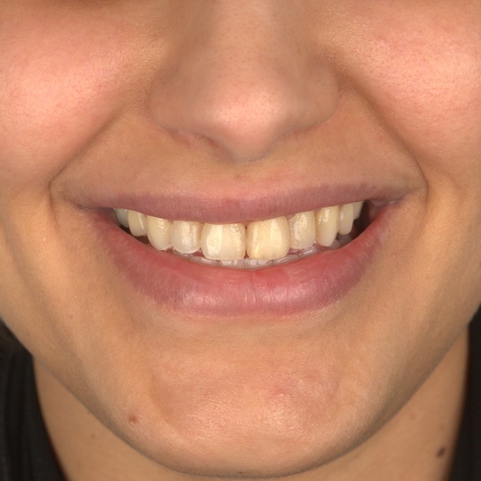 Before porcelain veneers