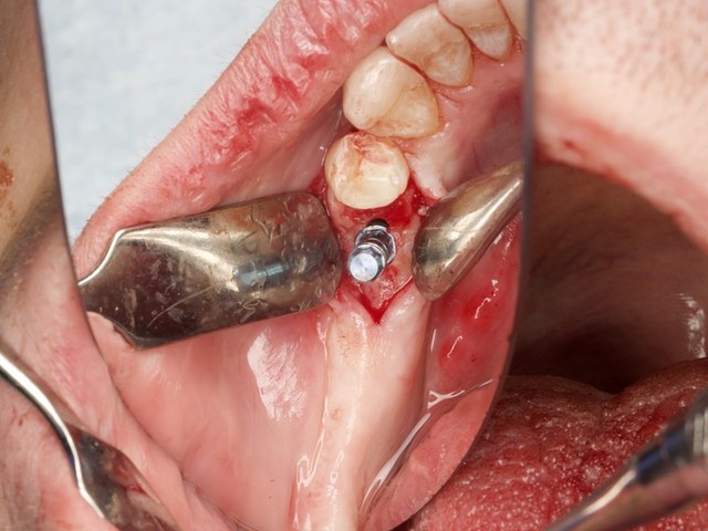 Final Implant Position
