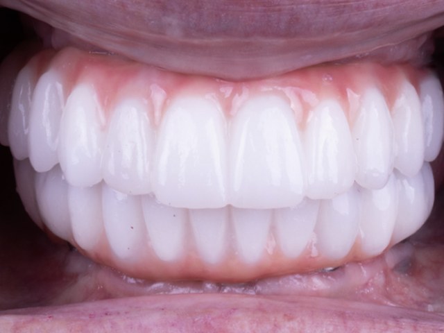 Final Prosthesis — Close-Up