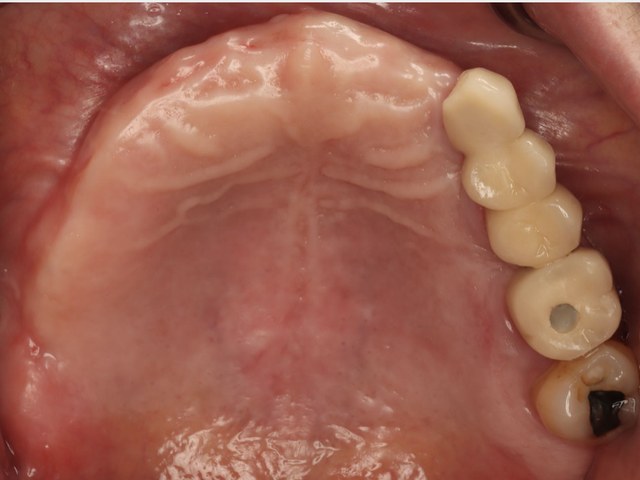 Final Prosthesis — Occlusal View
