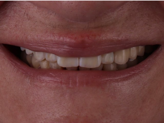 Final Smile Result