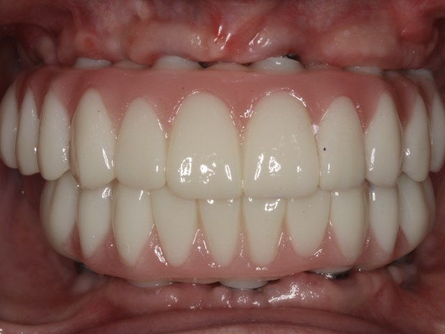 Final Zirconia Prosthesis