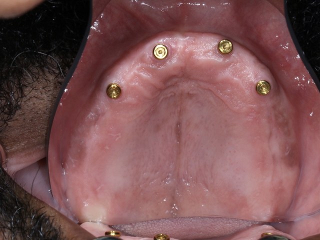 Healed Abutments
