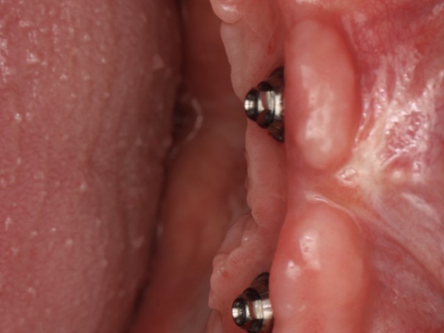 Healed Implants — Buccal View