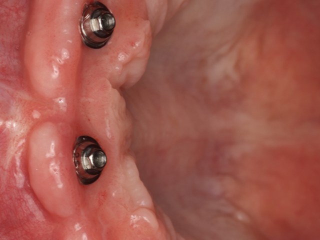 Healed Implants — Palatal View