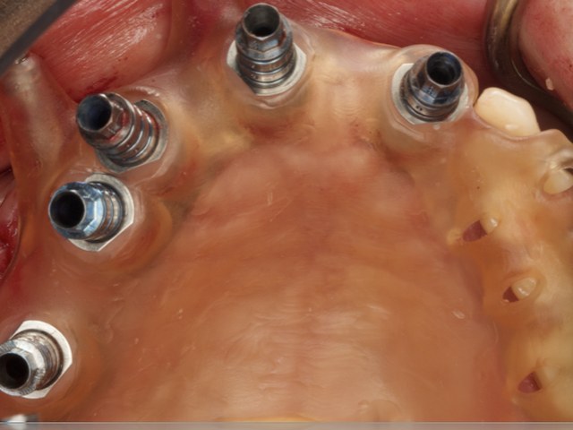 Immediate Abutment Connection