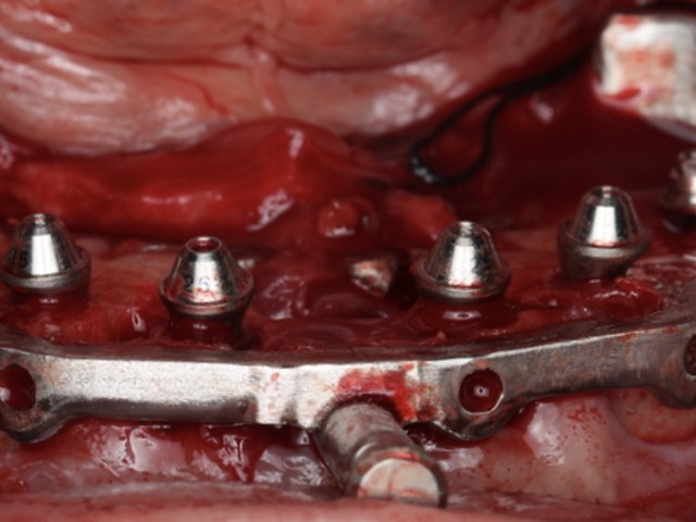 Immediate Implant Placement