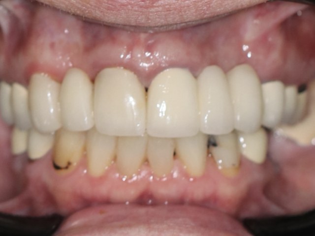 Immediate Provisional Prosthesis
