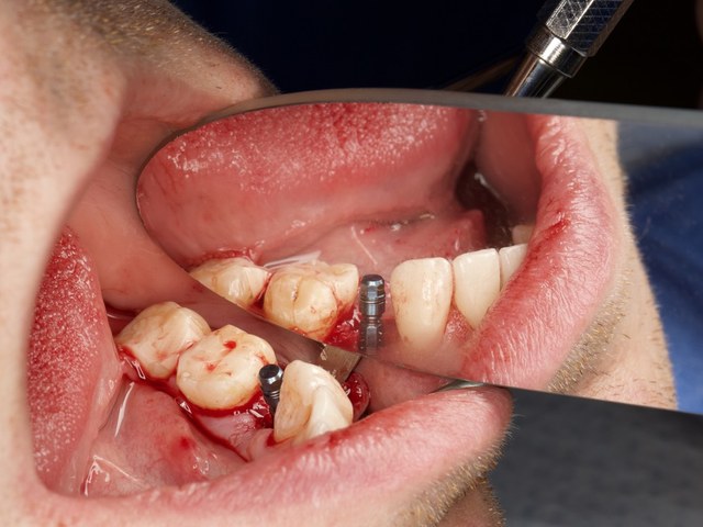 Implant Seating