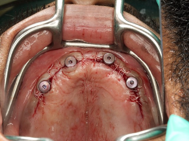 Multi-Unit Abutment Connection