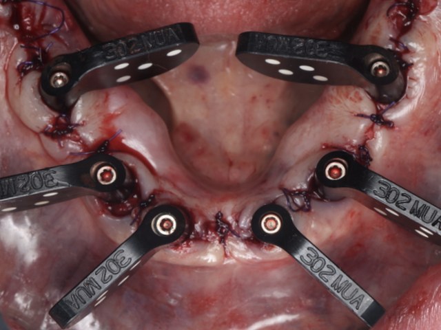 Multi-Unit Abutment Verification