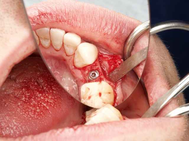 Osteotomy & Initial Placement