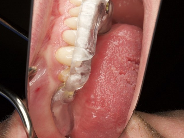 Prosthetic Verification