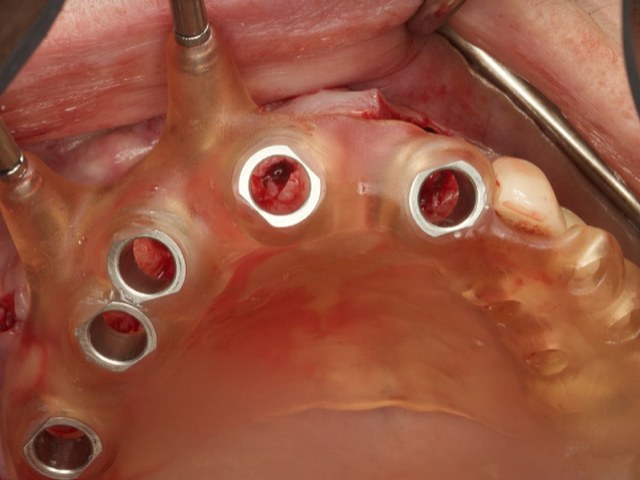 Surgical Guide Placement