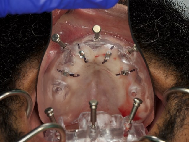 Surgical Guide Placement