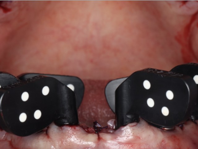 Verification Jig — Anterior View